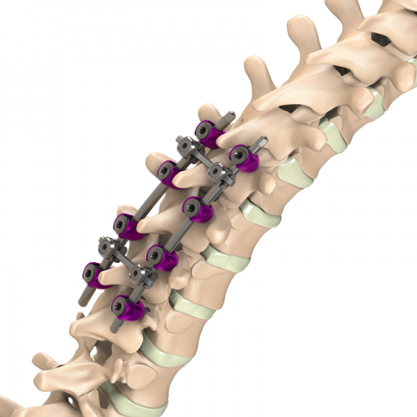 ADITUS SPINAL STABILIZATION SYSTEM