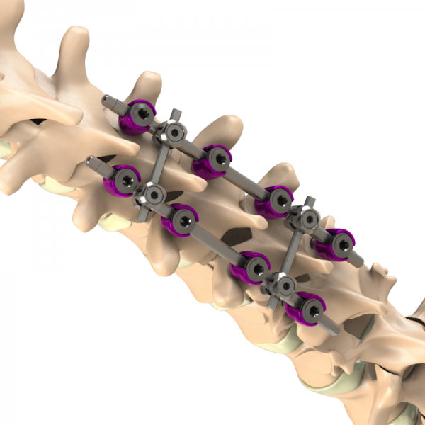 ADITUS SPINAL STABILIZATION SYSTEM