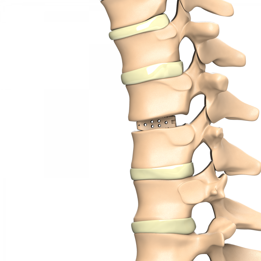 ADITUS LUMBAR PLIF CAGE