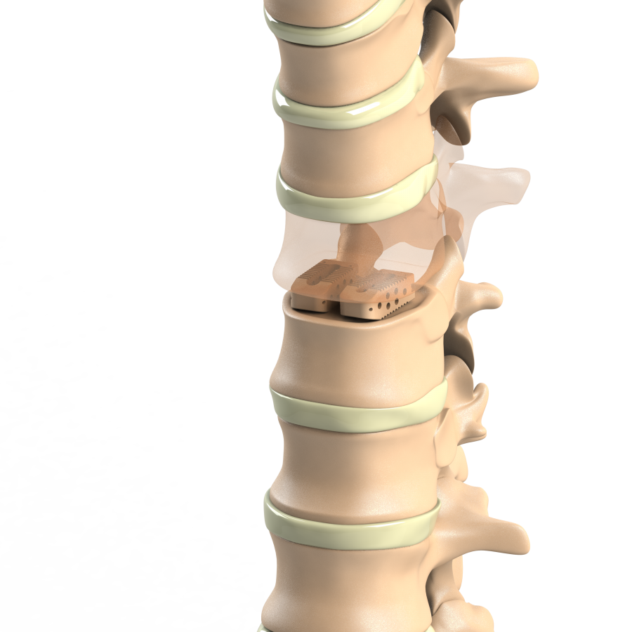 ADITUS LUMBAR PLIF CAGE