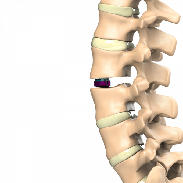 ADITUS LUMBAR DISC PROSTHESIS