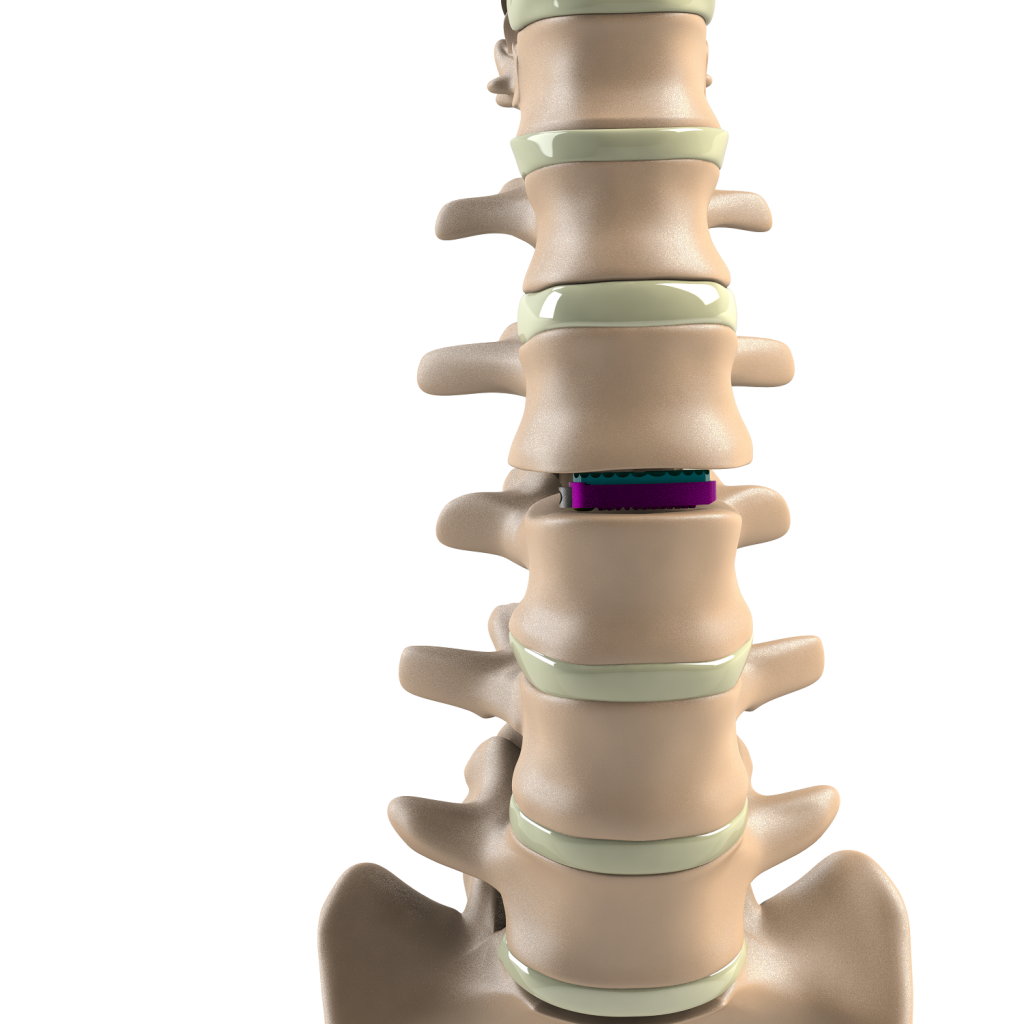 ADITUS LUMBAR DISC PROSTHESIS