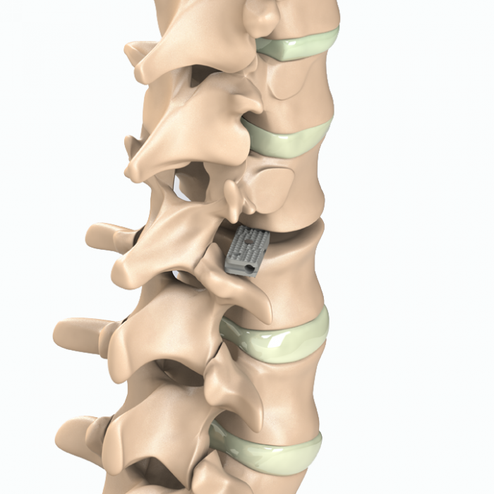 ADITUS LUMBAR XLIF CAGE