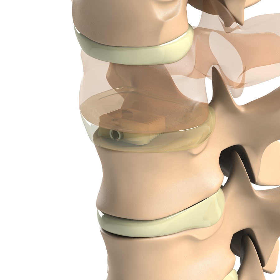 ADITUS CERVICAL CAGE