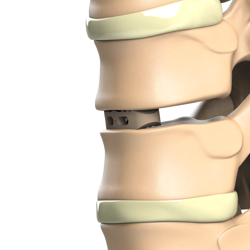 ADITUS LUMBAR TLIF CAGE