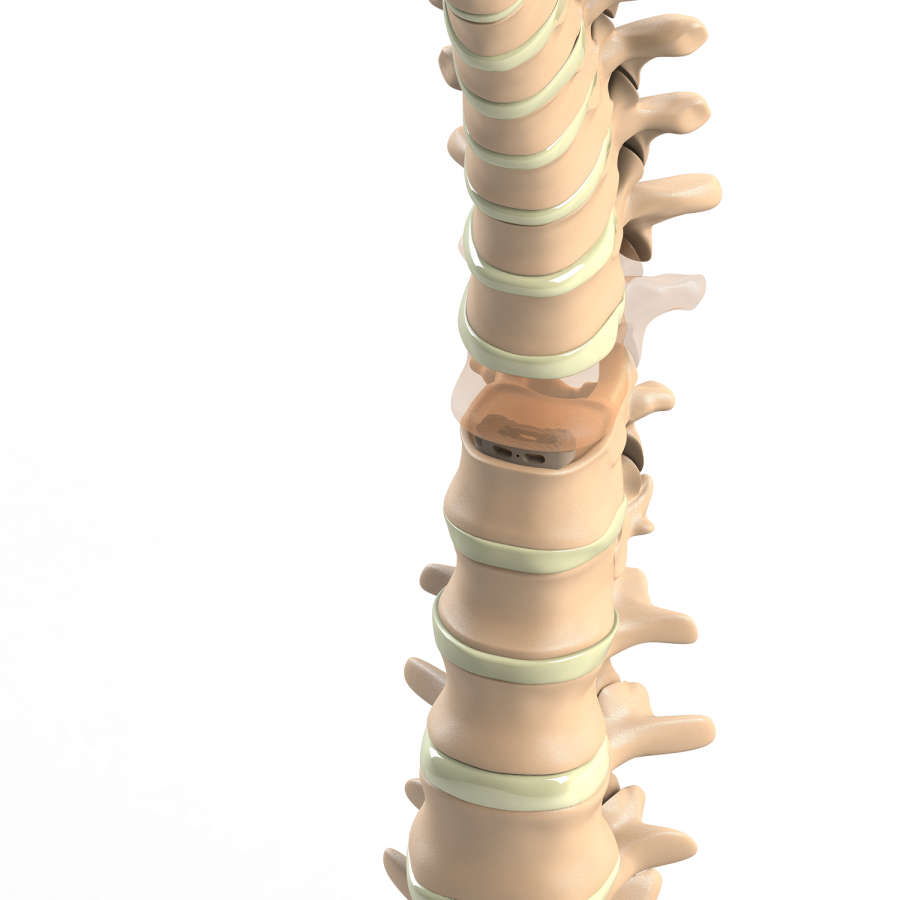 ADITUS LUMBAR TLIF CAGE