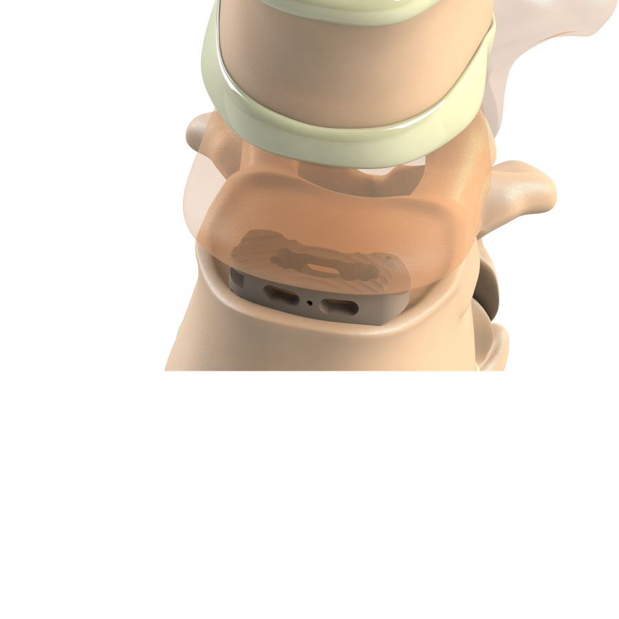 ADITUS LUMBAR TLIF CAGE