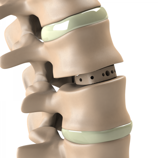 ADITUS LUMBAR ALIF CAGE
