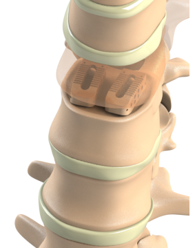 ADITUS LUMBAR PLIF CAGE