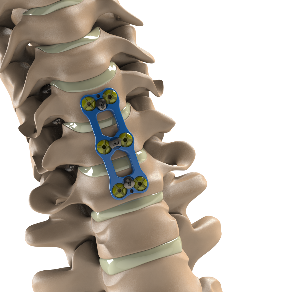 ADITUS ANTERIOR CERVICAL PLATE SYSTEM