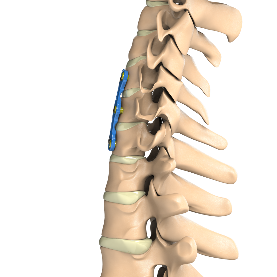 ADITUS ANTERIOR CERVICAL PLATE SYSTEM