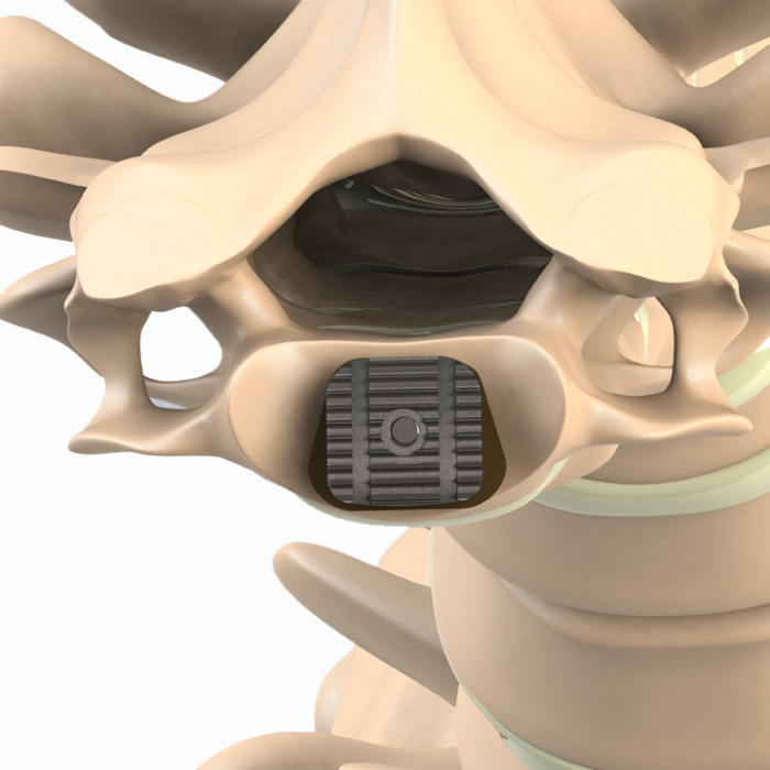 ADITUS CERVICAL DISC PROSTHESIS