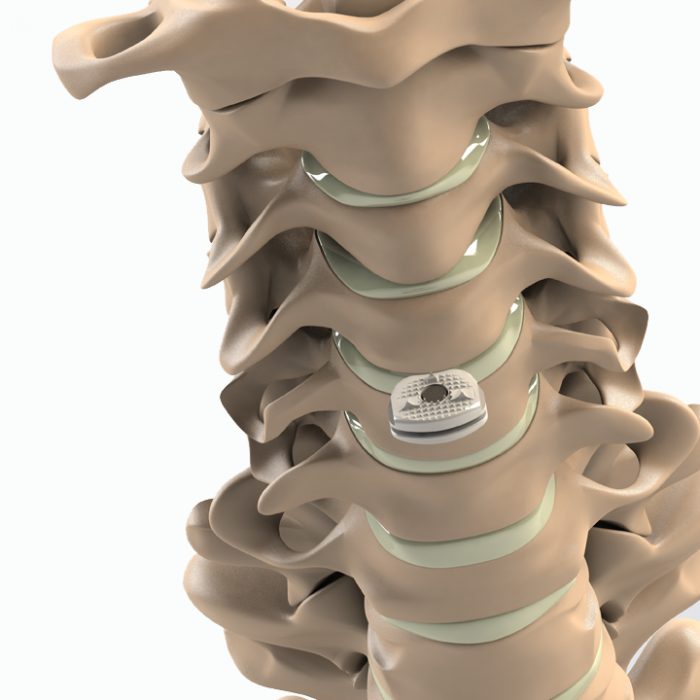 ADITUS CERVICAL DISC PROSTHESIS