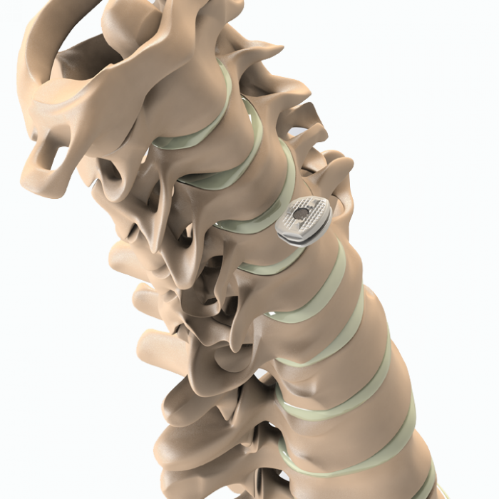 ADITUS CERVICAL DISC PROSTHESIS