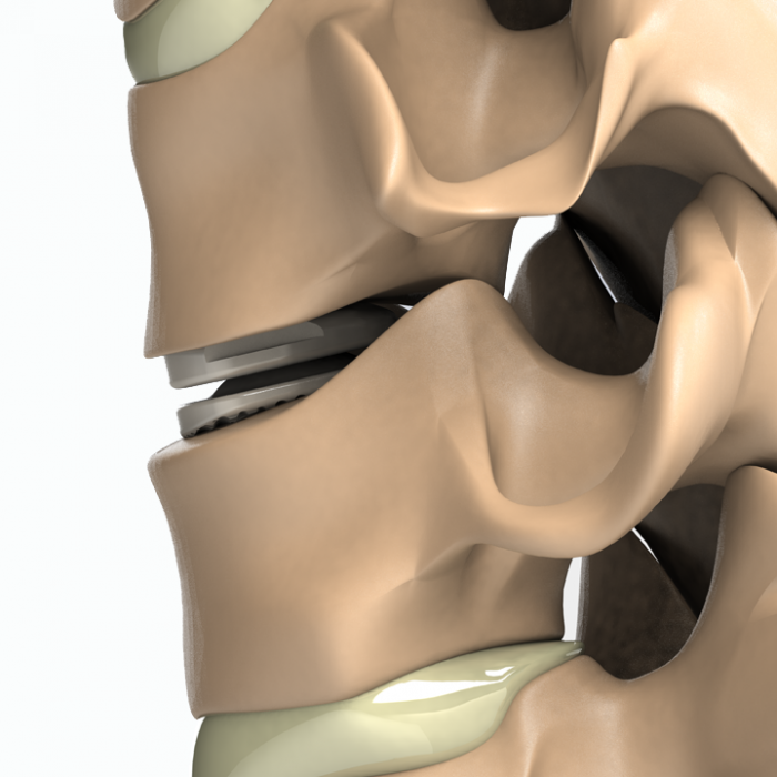 ADITUS CERVICAL DISC PROSTHESIS