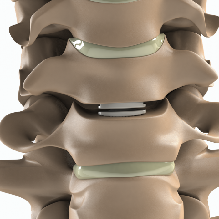 ADITUS CERVICAL DISC PROSTHESIS
