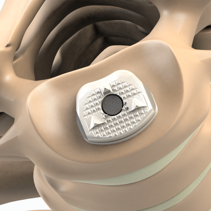ADITUS CERVICAL DISC PROSTHESIS