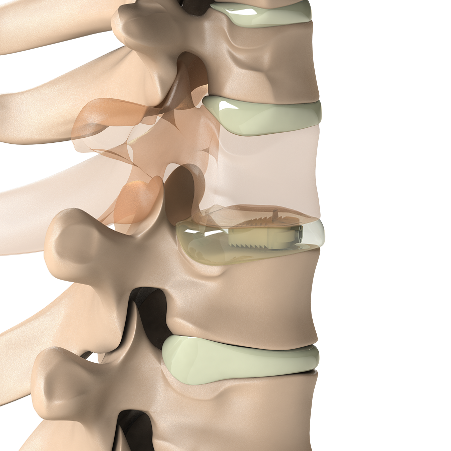 ADITUS CERVICAL CAGE