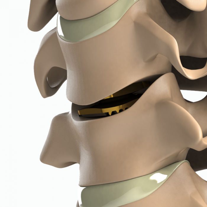 ADITUS CERVICAL DISC PROSTHESIS