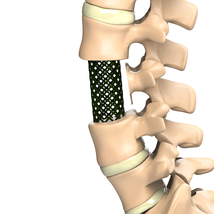 Aditus Corpectomy Mesh